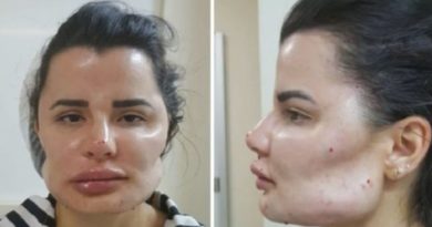 「ムラカミを許すな!」 ブラジル日系・美容整形外科医を相手に40名の患者が集団訴訟 日系ブラジル人美容整形外科医を患者40名が訴える