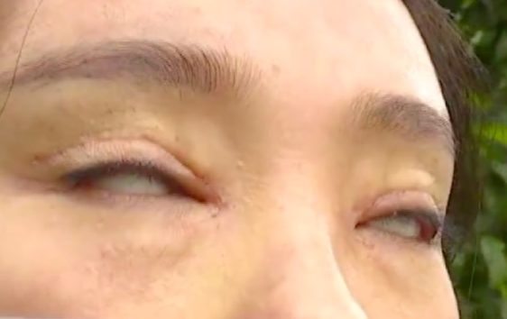 やりすぎた二重瞼整形手術で目が閉じなくなった女性